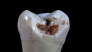 Ten-Second Treatment Shows Promise to Stop Cavities in Young Children