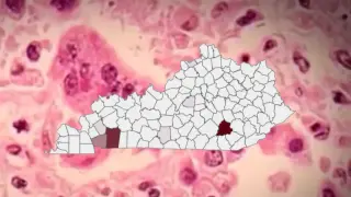 Kentucky Measles Cases Hit 157 as Laurel County Cluster Grows