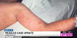 Alabama Health Officials Identify 195 Contacts in Huntsville Measles Investigation