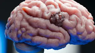 Glioblastoma Achilles heel spotted, hints at stronger therapies