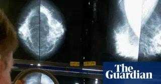 Study finds NICE breast cancer criteria miss most young at-risk women