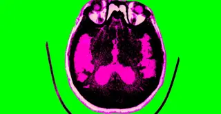 Alzheimer’s research shows real progress with new drugs and broader targets