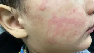 NC health officials flag Hendersonville Exxon and Asheville hotel as measles exposure sites