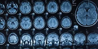 Childhood Trauma May Rewire Brain Networks That Fuel Procrastination in Adulthood