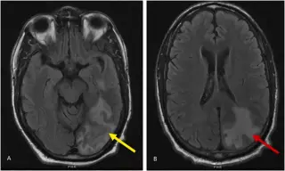 US Brain Fungus Cases Surge Fourfold, Baffling Scientists