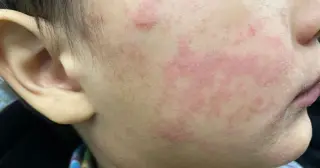 Measles cluster grows in upstate NY as exemptions rise