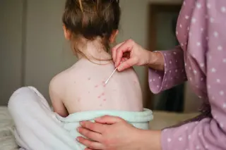 Florida Moves to Loosen School Vaccine Rules, Omitting Chickenpox Shot