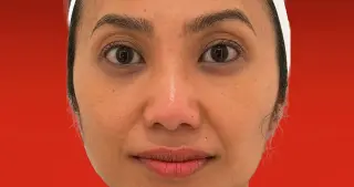 Under-Eye Nanofat: A Personal Look at Natural Skin Rejuvenation