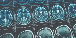 Neuroimaging Meta-Analysis Shows Opposite Brain Activity Patterns for Reward Processing in ADHD and Autism