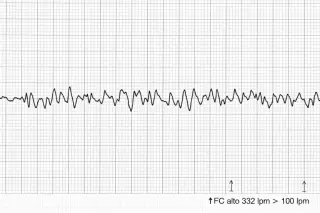 Perimyocarditis Triggers MINOCA and Sudden Cardiac Arrest in a Healthy Young Man