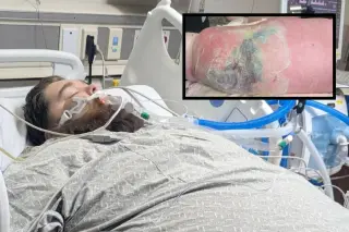 Idaho Father Battles Flesh-Eating Bacteria in ICU