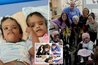 Ethiopian Craniopagus Twins Separated After 24-Hour Surgery in St. Louis