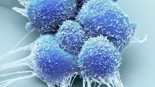 Prostate focal therapy: targeted treatment with hopeful early results but debated long-term proof