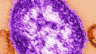 Wisconsin Measles Cases Reach 192 as Outbreak Spreads to Northern Counties