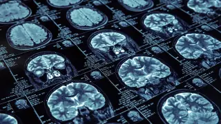 Arc Protein Emerges as Key Driver in Alzheimer’s Tau Spread