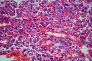 Why some cancers slip past detection—and how to spot them earlier