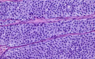 Oncologist Questions Whether Labeling DCIS as Cancer Drives Over-Treatment