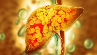 Ketogenic Diet Slashes Liver Fat by 67% in Obesity Trial