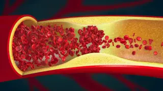 CKM Syndrome Tied to Early Arterial Injury in Most Young Adults