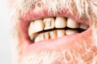 Two Stem-Cell Pathways Could Enable Real Tooth and Jawbone Regrowth