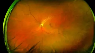 Rice-sized ENCELTO implant halts progression of rare MacTel eye disease