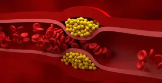 One-Shot CRISPR Therapy Sustains 52% Cholesterol Drop for One Year
