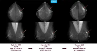 AI Screening Could Detect Breast Cancer Signs Up to Six Years Early, Massive Swedish Study Finds