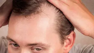 Big Real-World Study Finds Hair-Loss Drugs Do Not Increase Heart Disease Risk