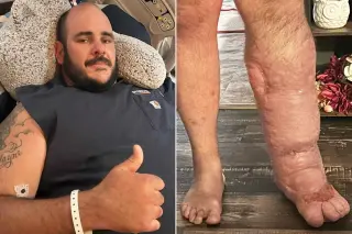 Florida Dad Finds Relief Through Leg Amputation After Flesh-Eating Bacteria Ordeal