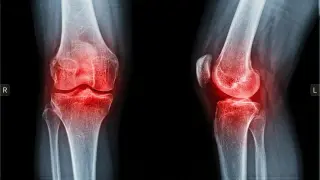 Personalized gait tweaks ease knee osteoarthritis pain, study finds