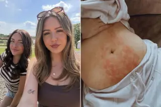 UK Sisters’ Pain Finally Leads to Endometriosis Diagnosis After Years of Dismissal
