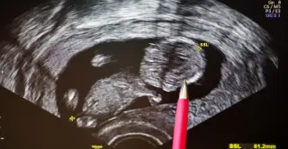 Preimplantation genetic testing expands beyond rare diseases to predict common health risks