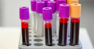 Multi-Cancer Blood Tests: Promise Hangs in the Balance