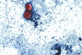 Lettuce-Linked Cyclospora Outbreak Expands to 20 States