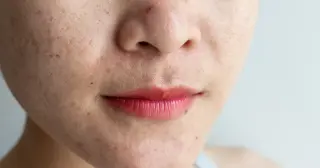 Skin Flares May Reveal Hidden Heart Risk, Dermatologist Says