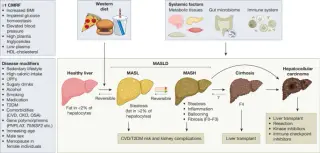 MASH Unraveled: Molecular Drivers of Steatohepatitis and Cancer Risk in MASLD