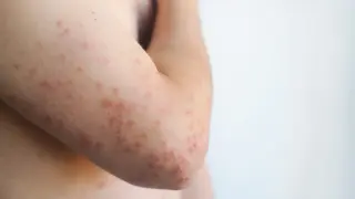 Pennsylvania records fifth measles death as federal tally dispute persists