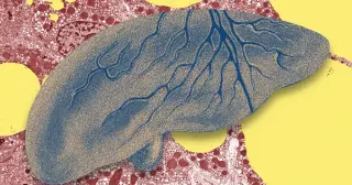 AI Could Catch Fatty Liver Disease Early, Saving Livers and Lives