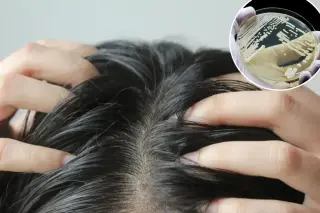 Deadly fungus Candida auris hides in hair follicles as cases rise across 23 states