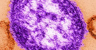Delaware records first measles case in over a decade, prompting public health actions