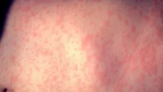 Breakthrough Measles Case Prompts Exposure Alerts in KC Suburbs