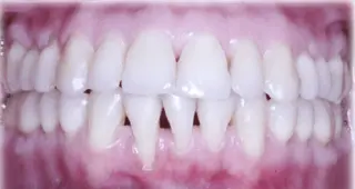 Connective Tissue Graft with Coronally Advanced Flap Restores Root Coverage in Post-Orthodontic Gingival Recession: A Case Report
