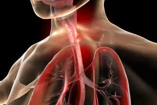 Barrett’s Esophagus Emerges as the Universal Origin of Esophageal Cancer