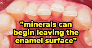 Dentists Warn Yogurt Can Harm Your Enamel, Even as a Health Snack