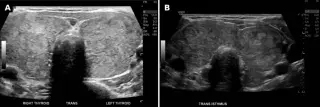 Severe LDL-C Elevations Reversed by Restoring Thyroid Hormone in a Post-Thyroidectomy Patient