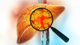 Mayo Clinic Study Reveals Fatty Liver Disease Is Five Distinct Conditions, Not One