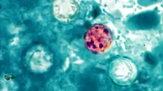 Douglas County Sees Cyclospora Surge Tied to Iceberg Lettuce