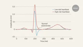 AI-powered ECG clues reveal hidden risk group for sudden cardiac death