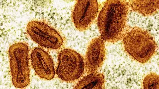 Two government scientists charged with smuggling deactivated mpox into the U.S.
