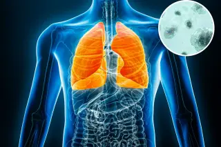 Lung cancer patients show higher microplastic burden in lungs, study finds